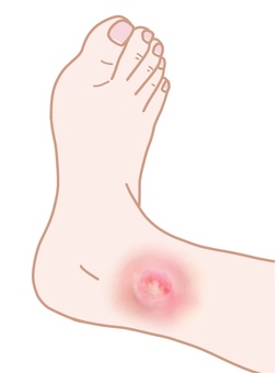 Foot low temperature burn necrosis ankle Foot low temperature burn necrosis ankle