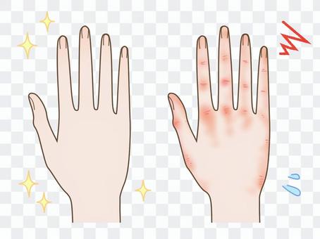 きれいな手とあかぎれの手 比較 きれいな手とあかぎれの手 比較